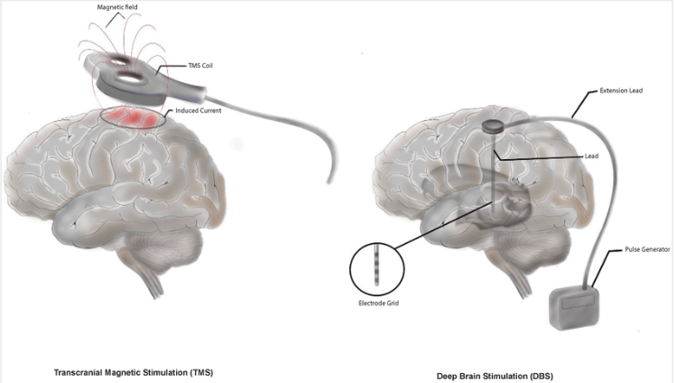 Illustrative representation of brain and regions addressed during TMS therapy and DBS therapy